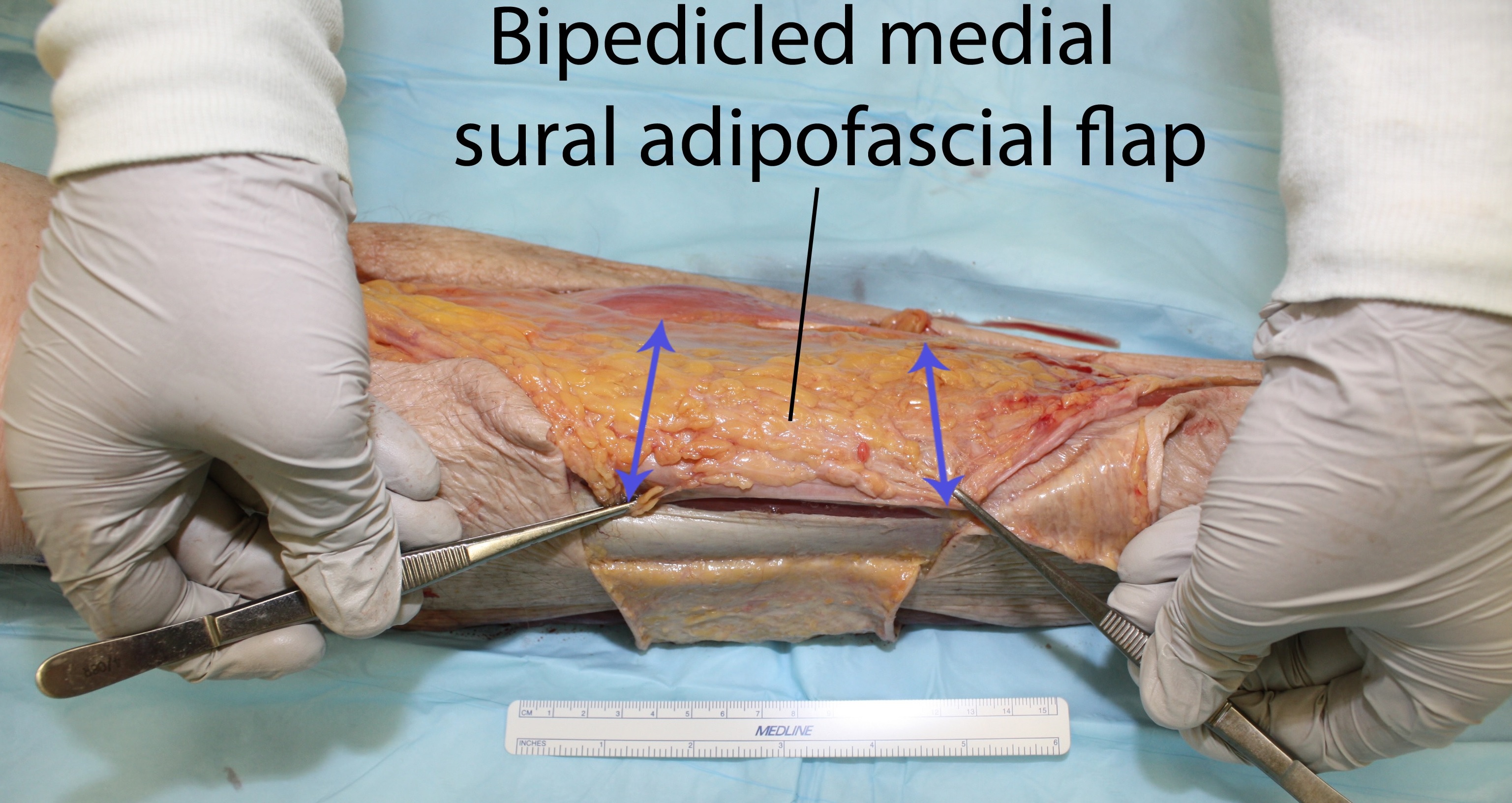 NESPS - Bipedicled Medial Sural Adipofascial Flap for Coverage of