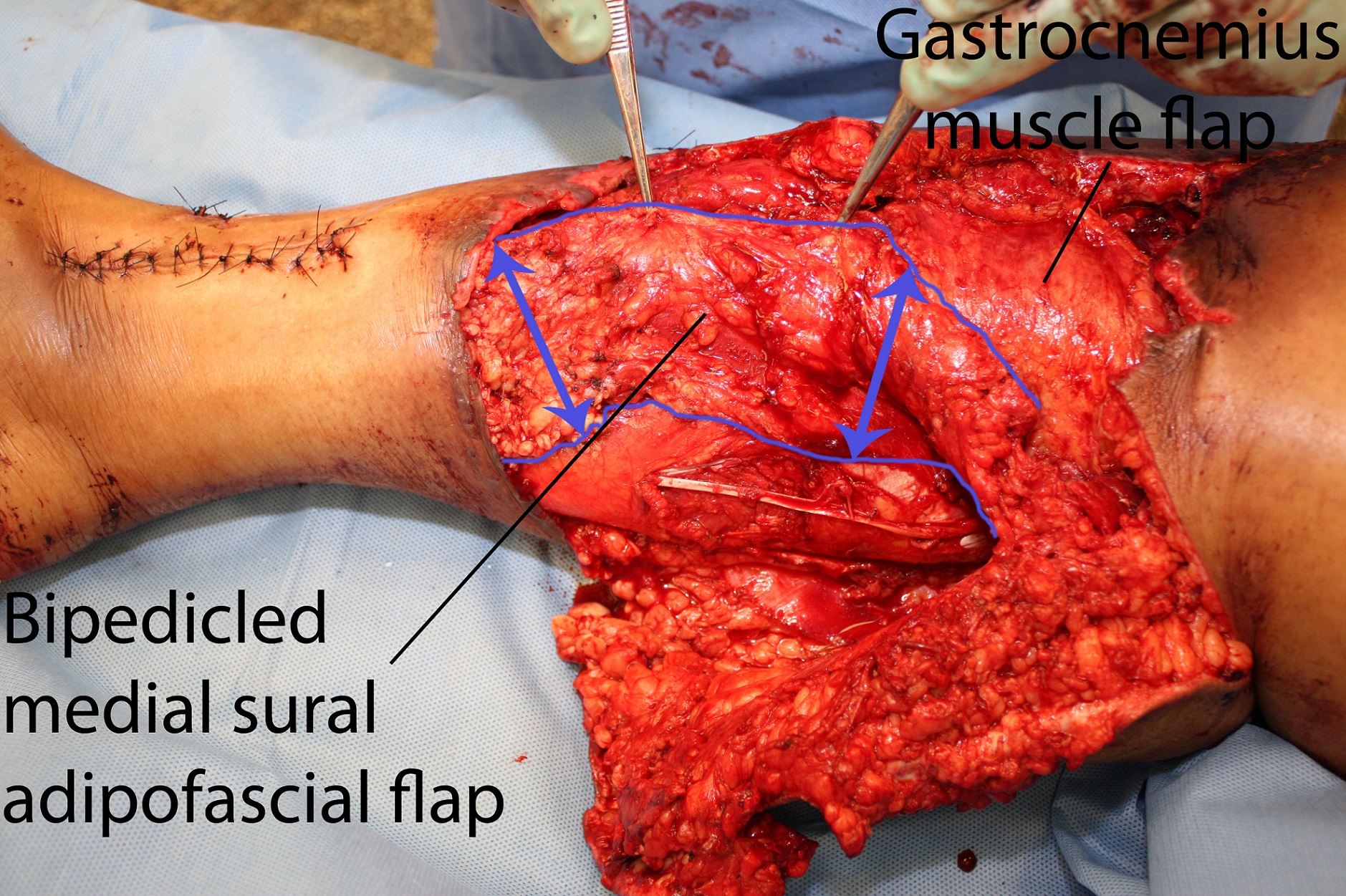 NESPS - Bipedicled Medial Sural Adipofascial Flap for Coverage of