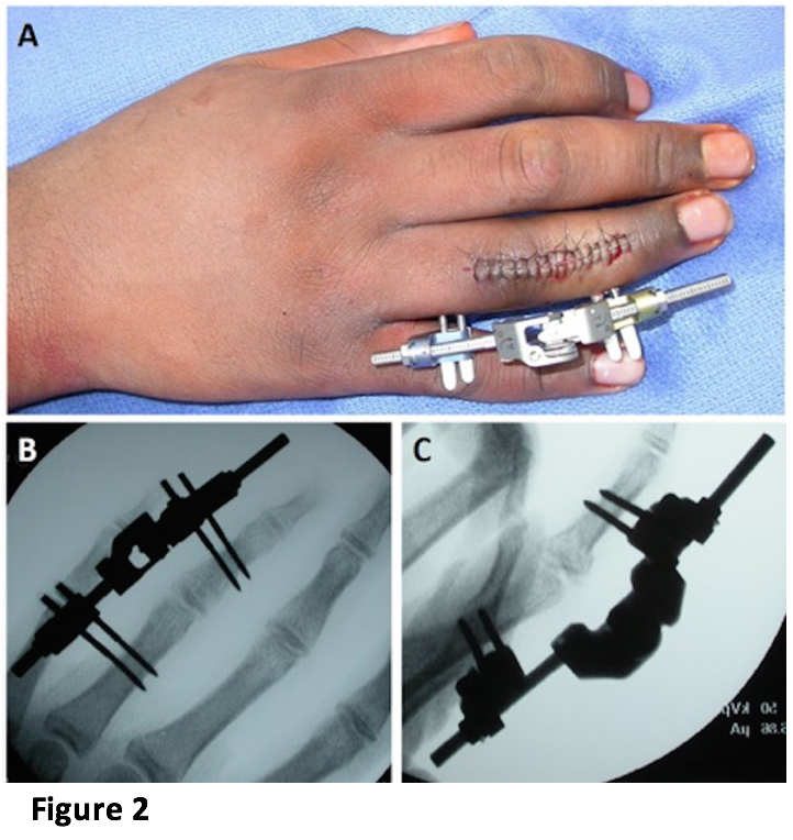 dynamic traction phalanx pilon fracture